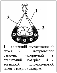 Подпись: 
1 – зовнішній поліетиленовий пакет; 2 – ампутований сегмент, загорнений в стерильний матеріал; 3 - зовнішній поліетиленовий пакет з водою і льодом.
